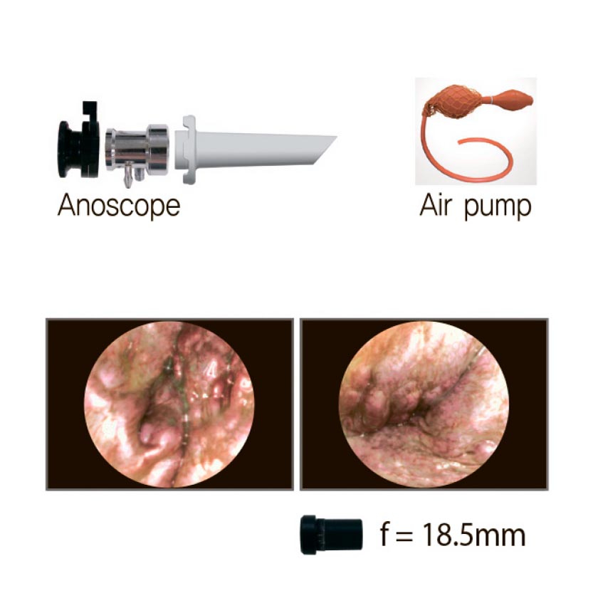 Video Rectoscope